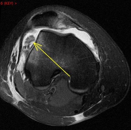 Figure 5 for case Patellar dislocation